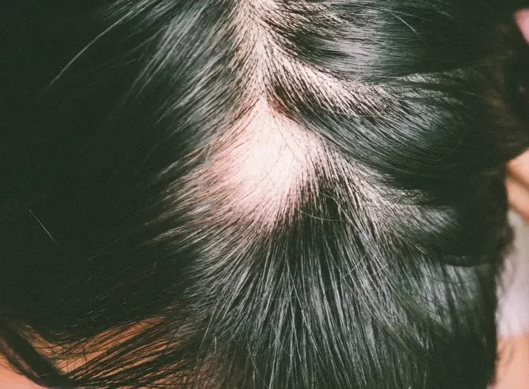 Saiba o que é alopecia e quais os tipos e tratamentos