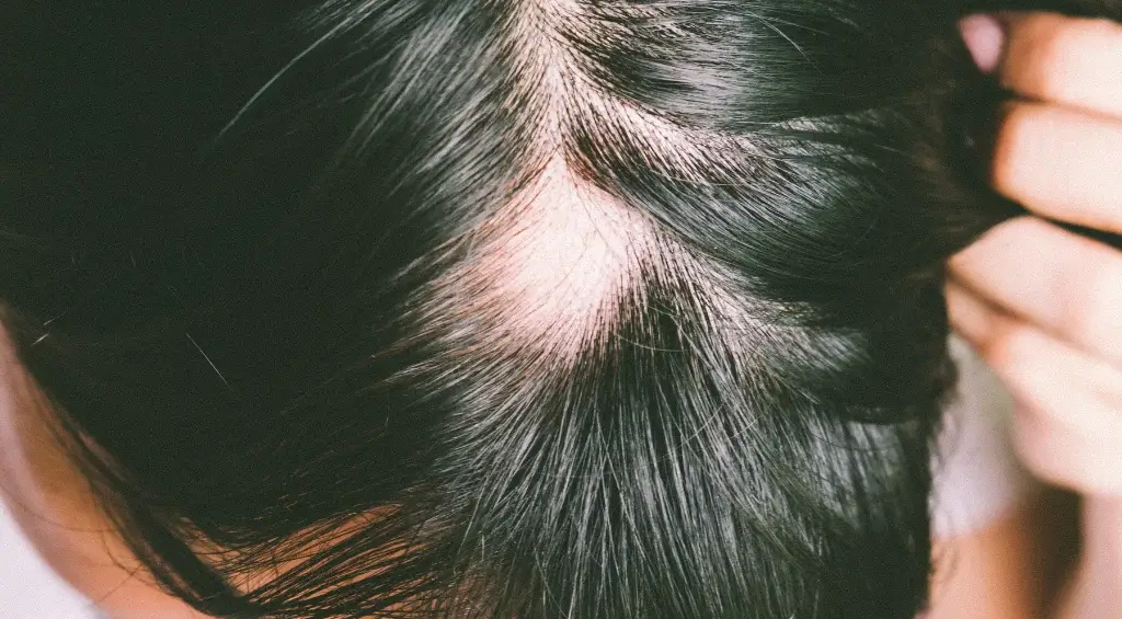 o que é alopecia